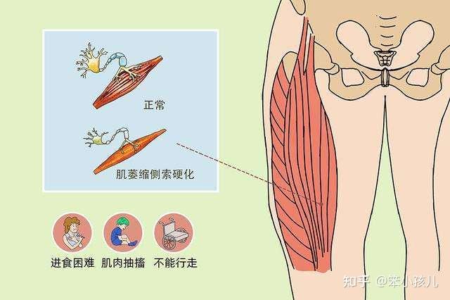 這個病變的部位在於大腦皮層運動區細胞還有脊髓的前角細胞,肌萎縮