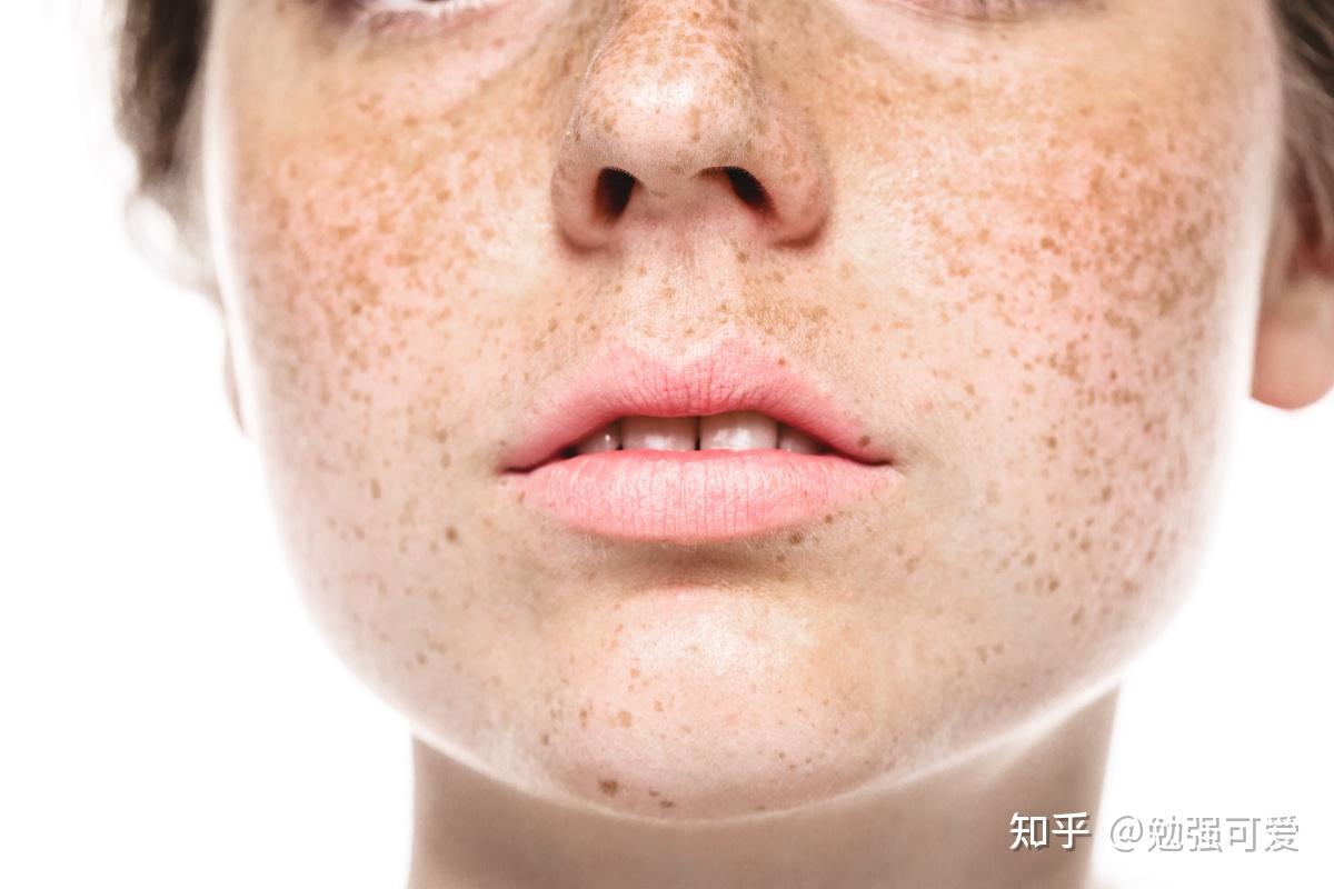 雀斑会越来越多吗雀斑会遗传给下一代吗