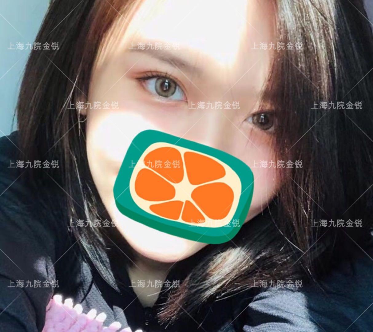 上海九院金锐双眼皮案例