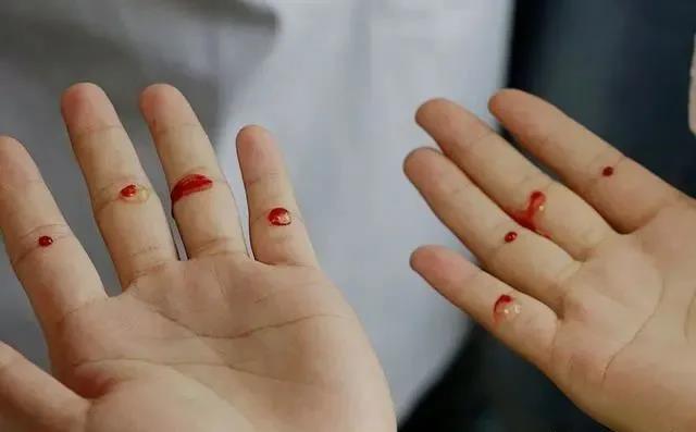 四缝穴,扎一次见效,二次痊愈,真是绝了!