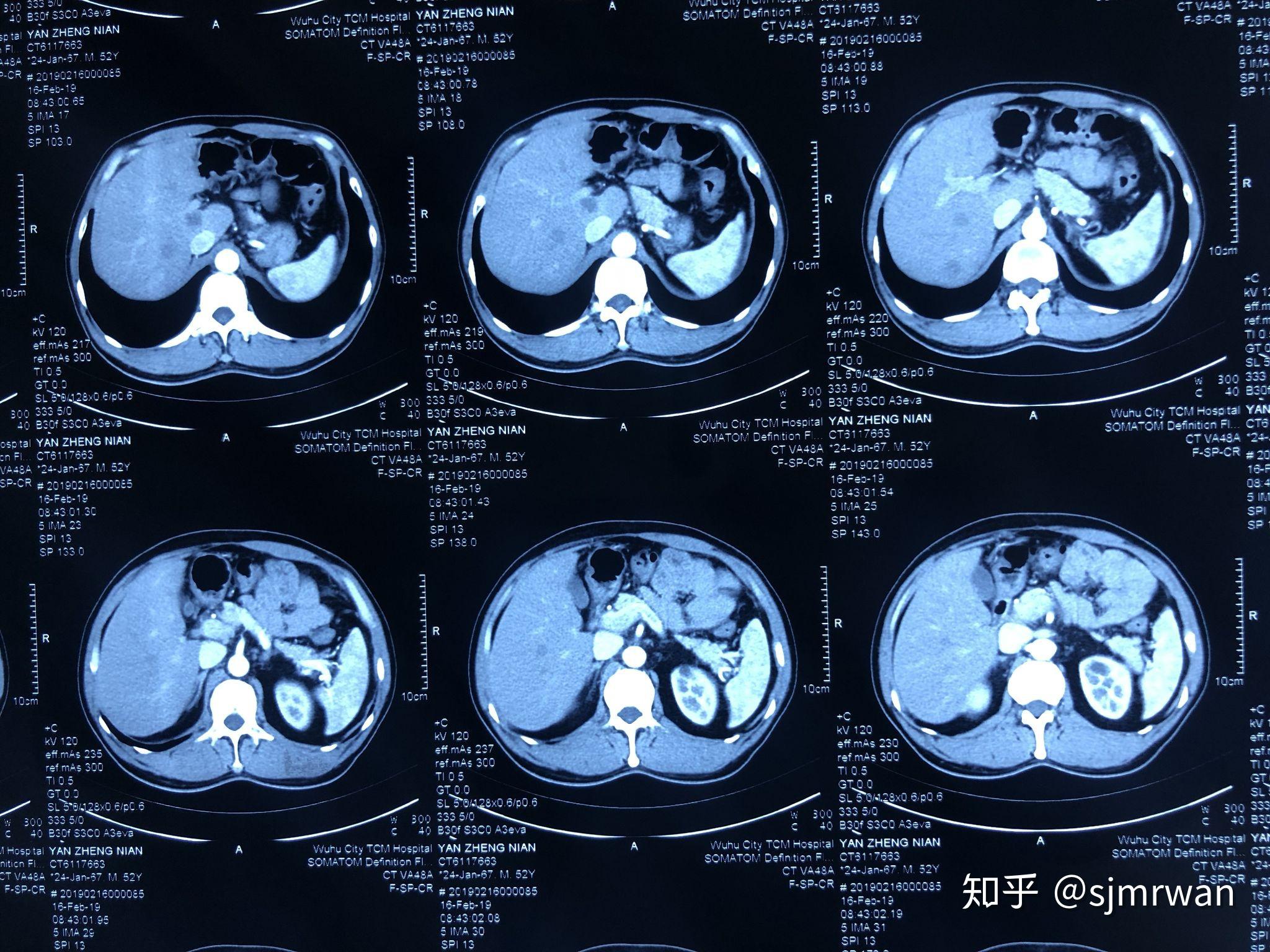图14-16 结肠憩室(CT三维图像)-外科学-医学