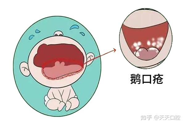 口腔里长了个白色的凸起，可能是这6种因素... - 知乎