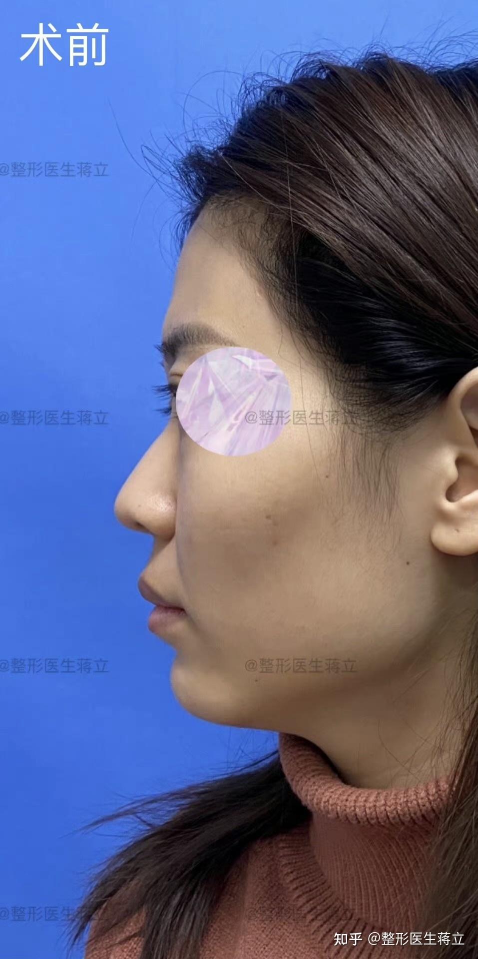 鼻小柱略微退缩鼻头和下小叶缺乏表现点鼻头下悬鼻翼高低不同鼻翼基底