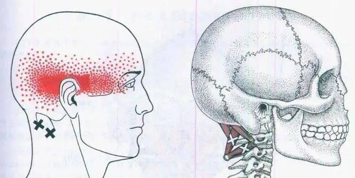 頭暈頸椎難受教你高效處理枕下肌群解決這些問題