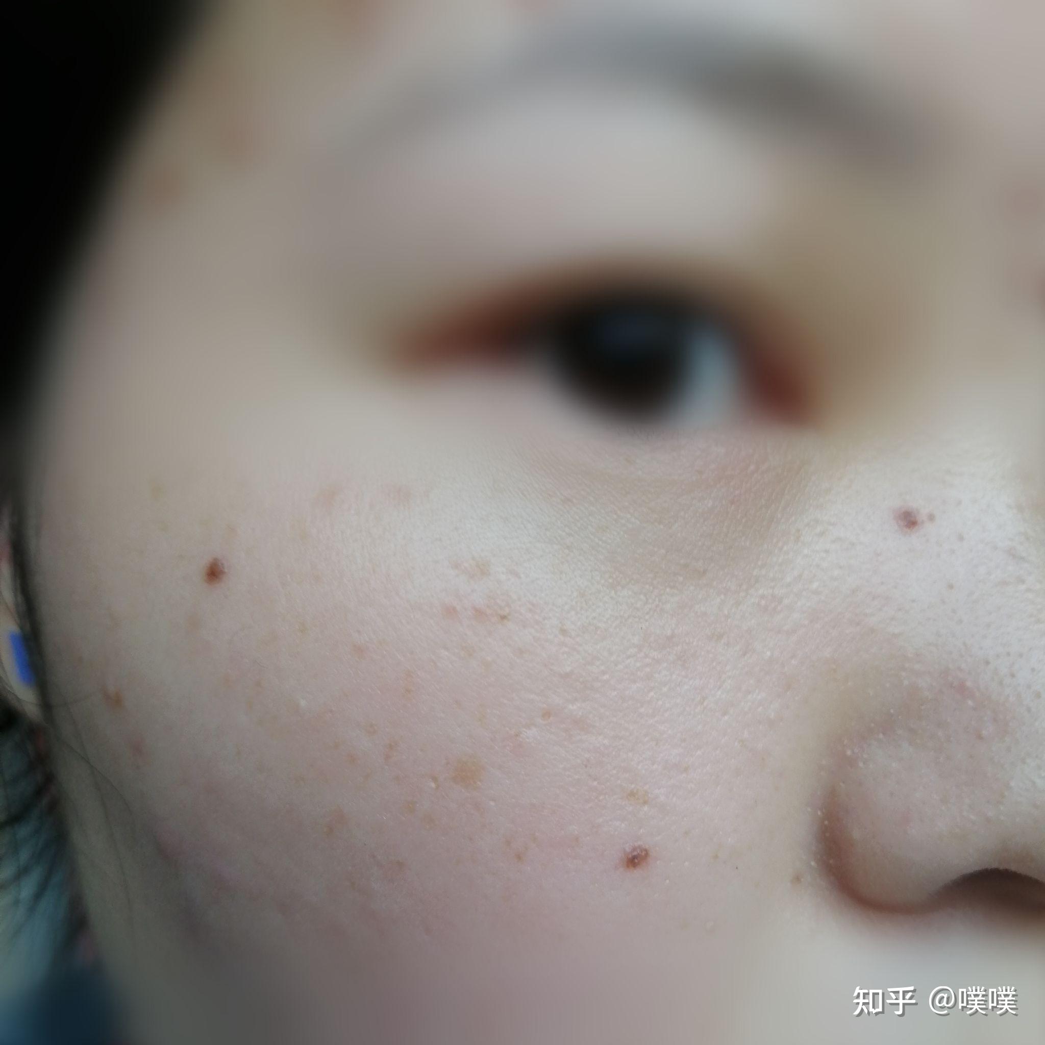 液氮冷冻点痣记录贴