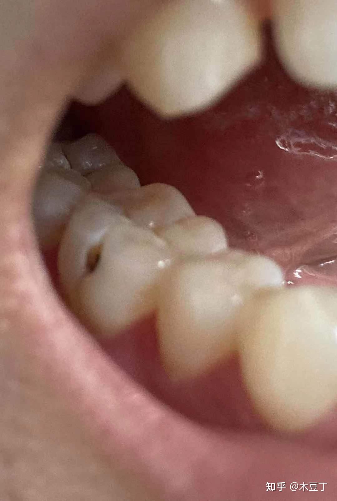 牙齿侧面蛀牙补牙图图片
