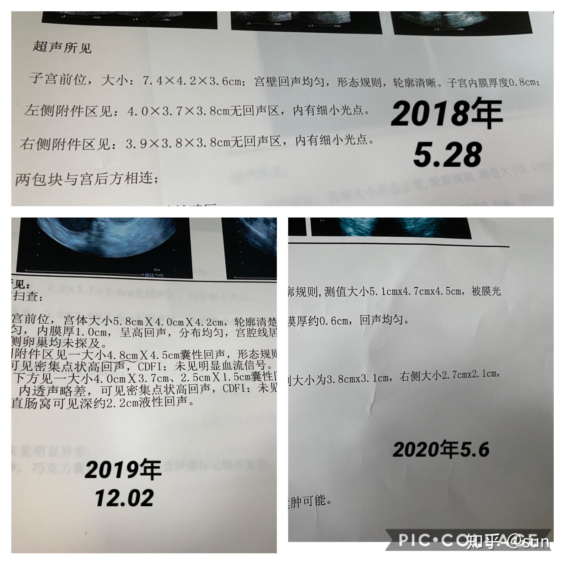 优思明治疗巧克力囊肿记录