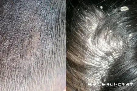 头皮癣怎么治才能除根?头皮癣的症状及治疗方法 - 知乎