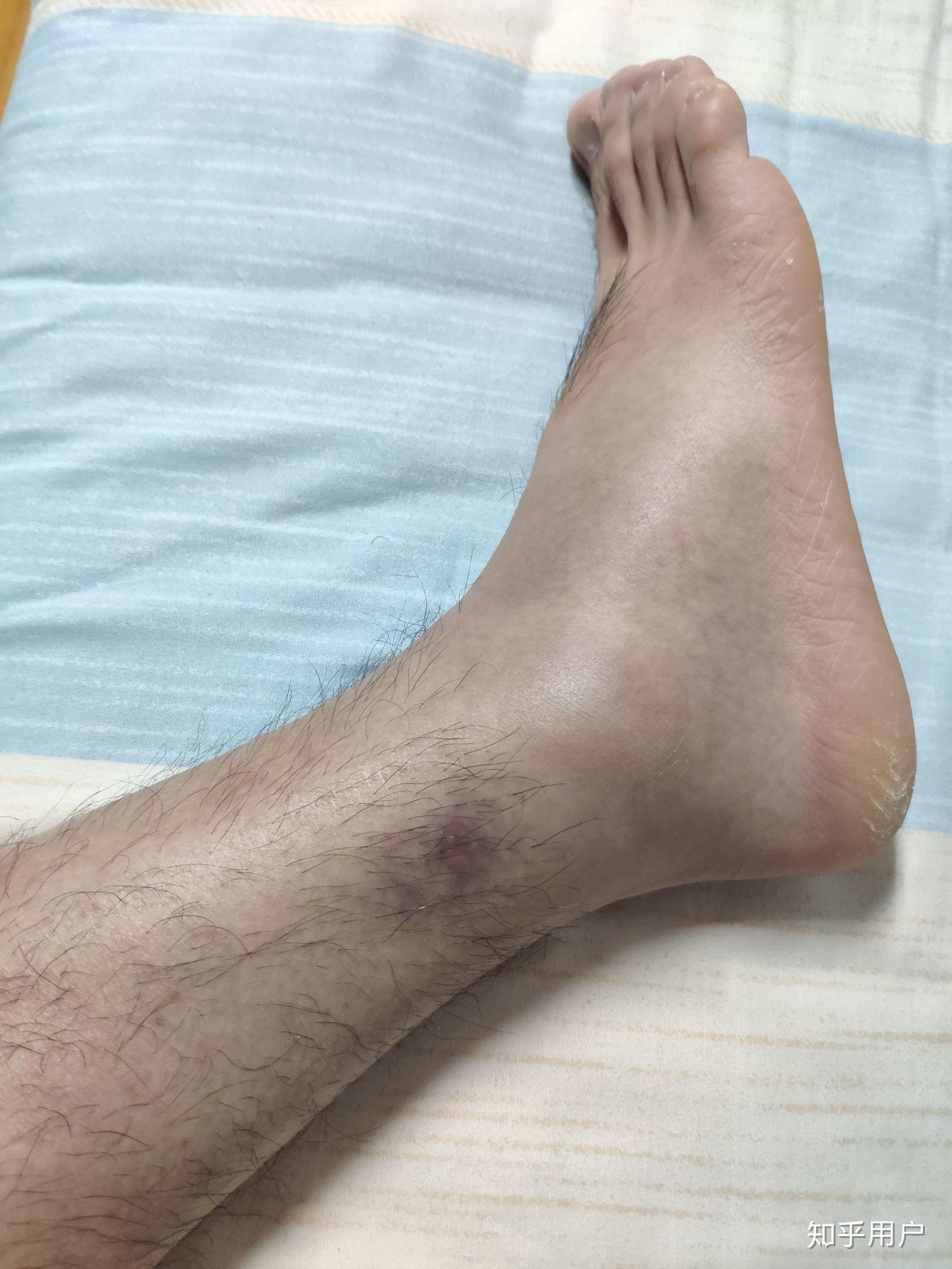 下巴和脖子交界处总长痘痘是什么原因,该怎么办? - 知乎