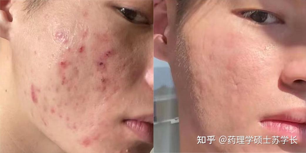 快被满脸痘印逼疯了,究竟如何才能彻底解决?专业配方师曝光最有效的去痘印方法,让你从大烂脸变成好皮肤 - 知乎