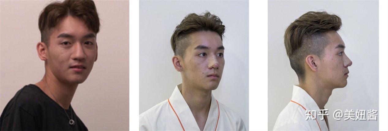 男生整容比女生更需要注意的点——男生隆鼻要自然,绝对不可以被人看