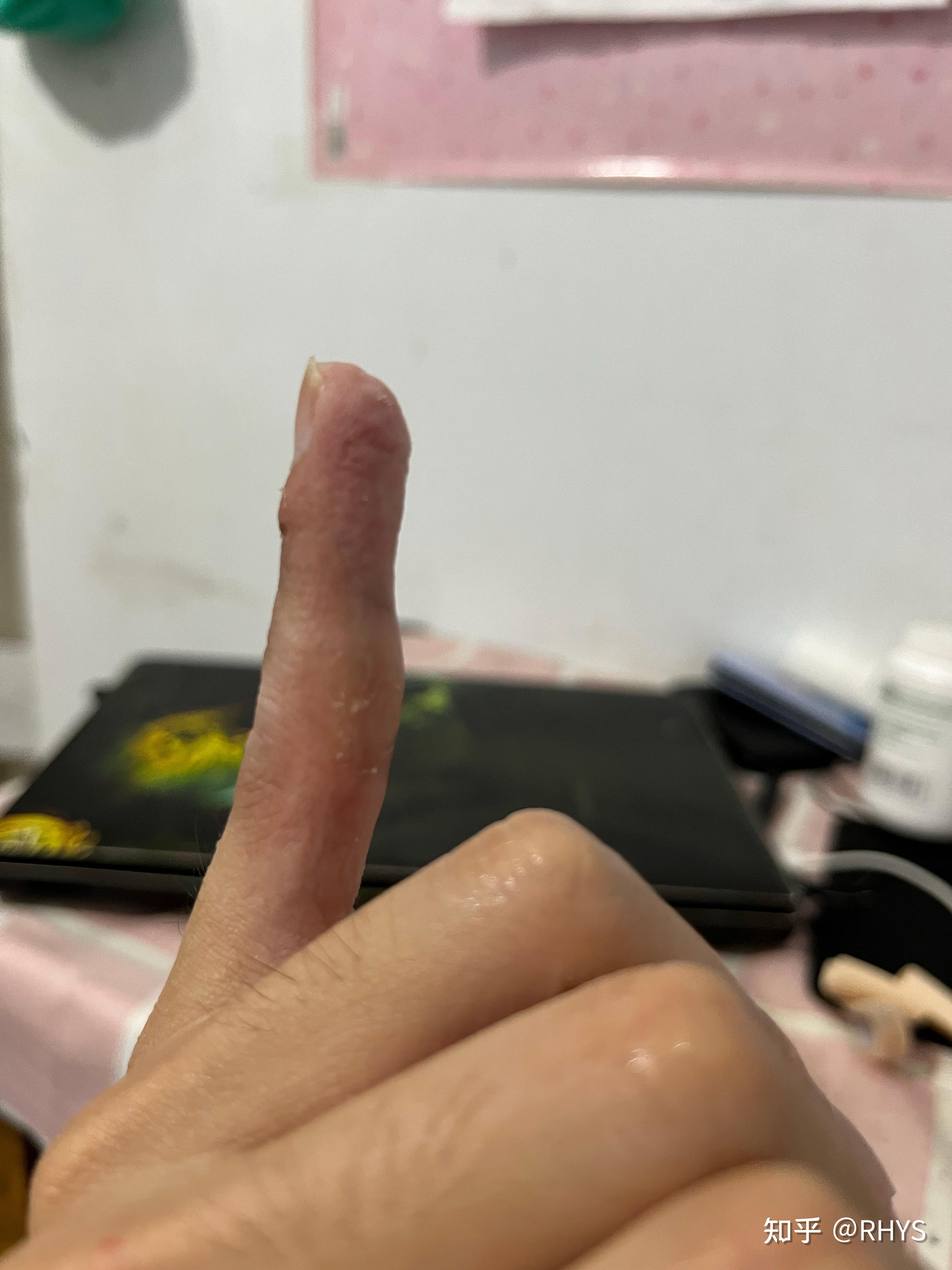 打球小拇指伸肌腱损伤或者断裂,保守治疗恢复过程