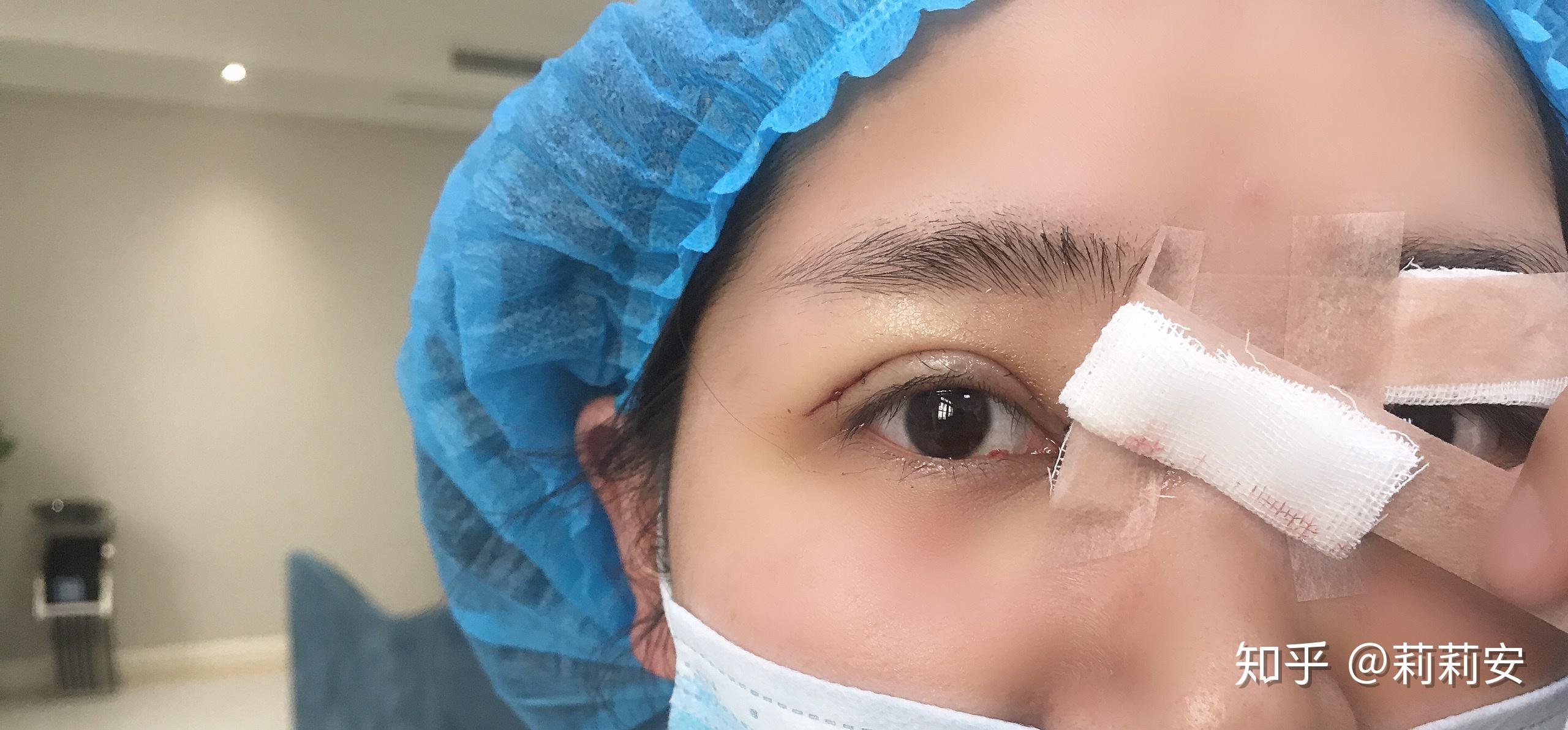 双眼皮术后即刻