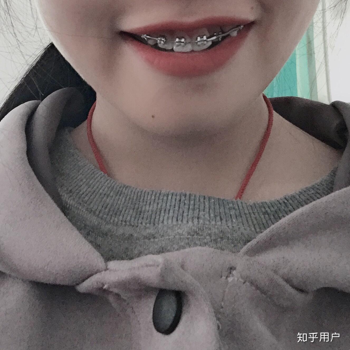 本人23,女,骨性地包天可以通过牙齿矫正来调整