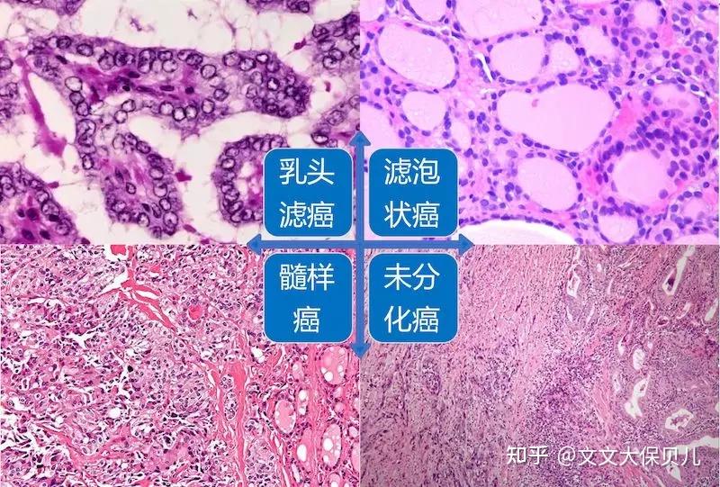 未分化癌 zhuanlan.zhihu.com