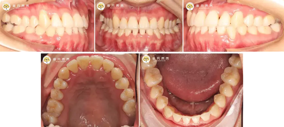 正畸病例嘴突地包天反病例一例