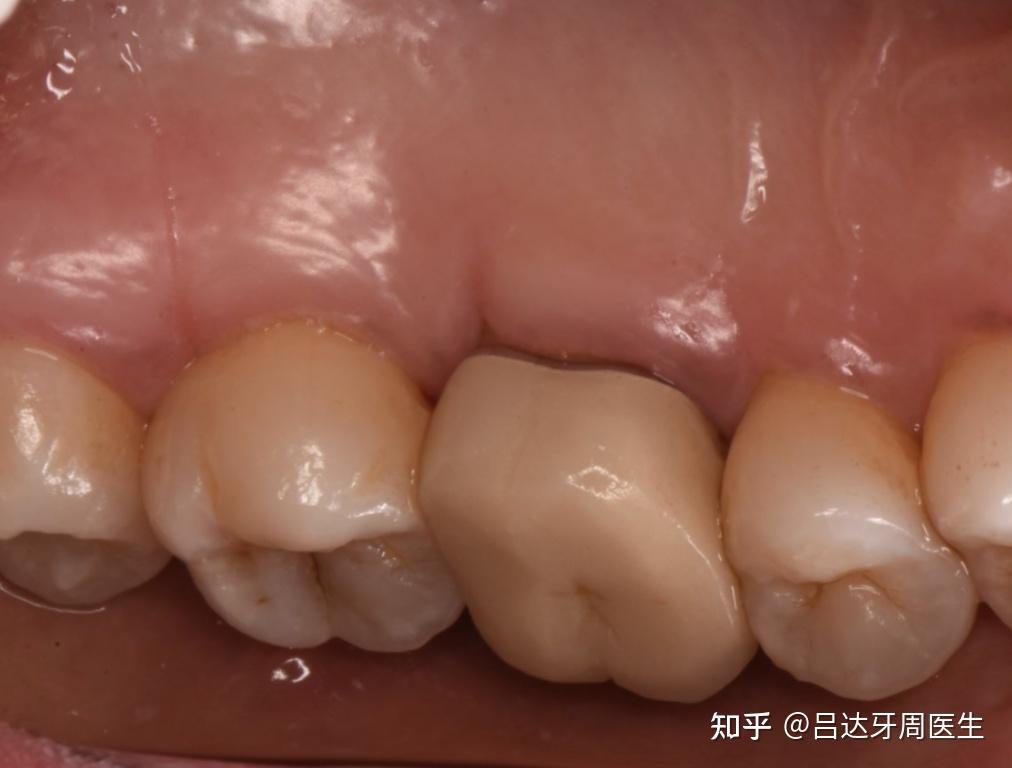 用牙线真的会损伤牙龈吗关键在方法