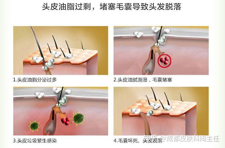 毛囊炎要如何用药