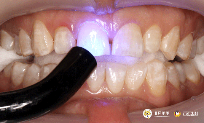 『教授经验』托槽粘接-间接粘接技术 | 下篇