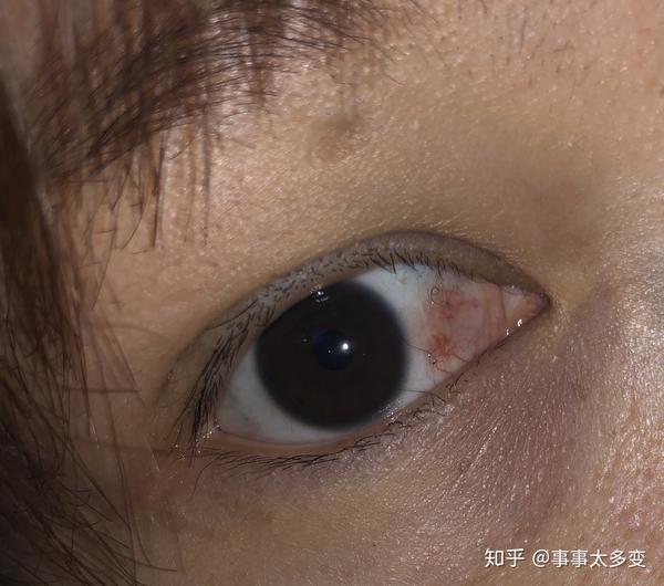 眼结膜色素痣图片