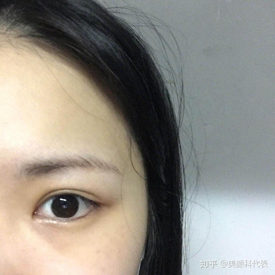 但我坚持不开,她就帮我眼头的位置调的高了一点,不然眼头就会被眼角包