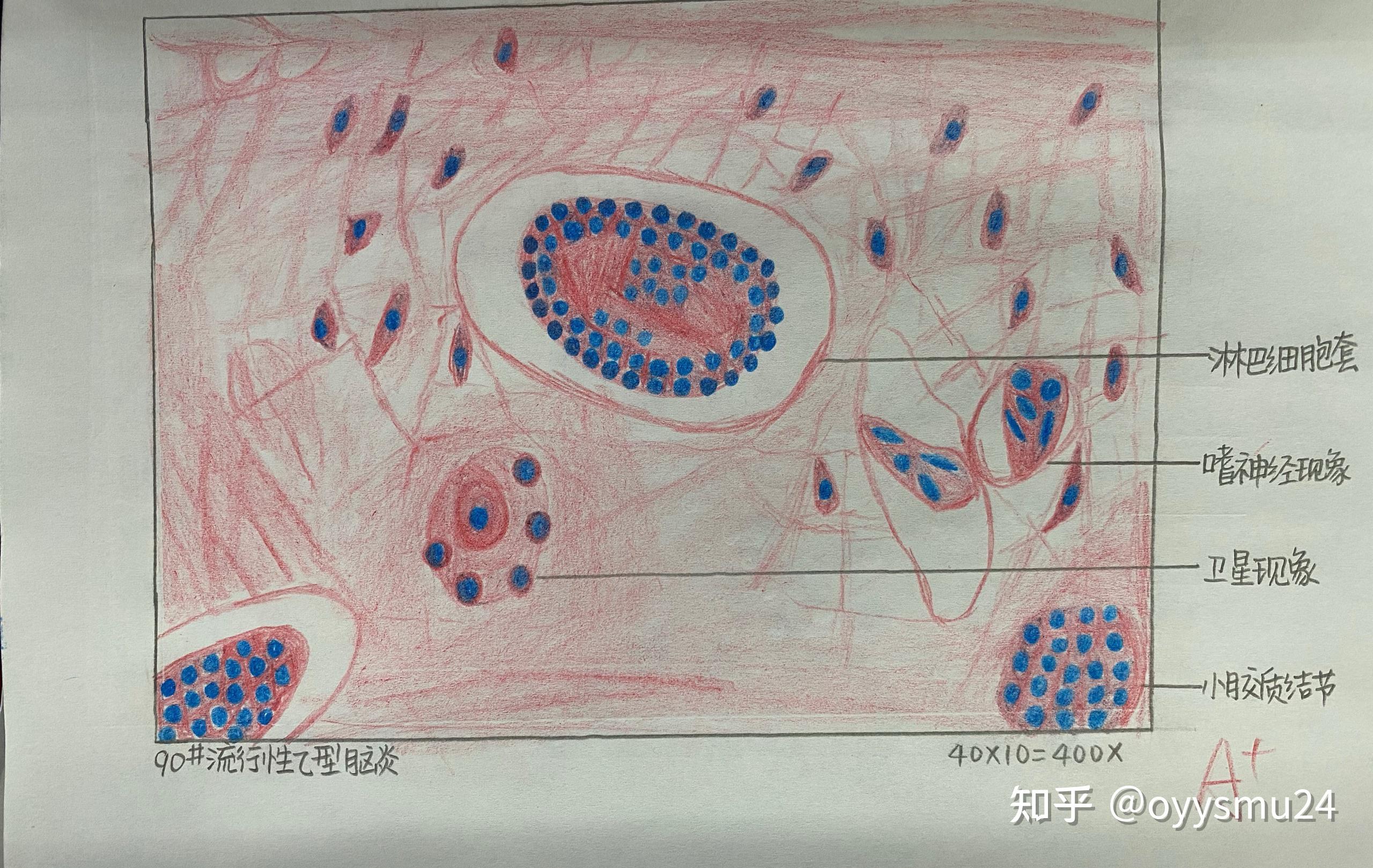 肺炎链球菌 红蓝铅笔图片
