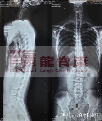 成年人脊柱侧弯,参加施罗斯强化班能改善吗? - 知乎