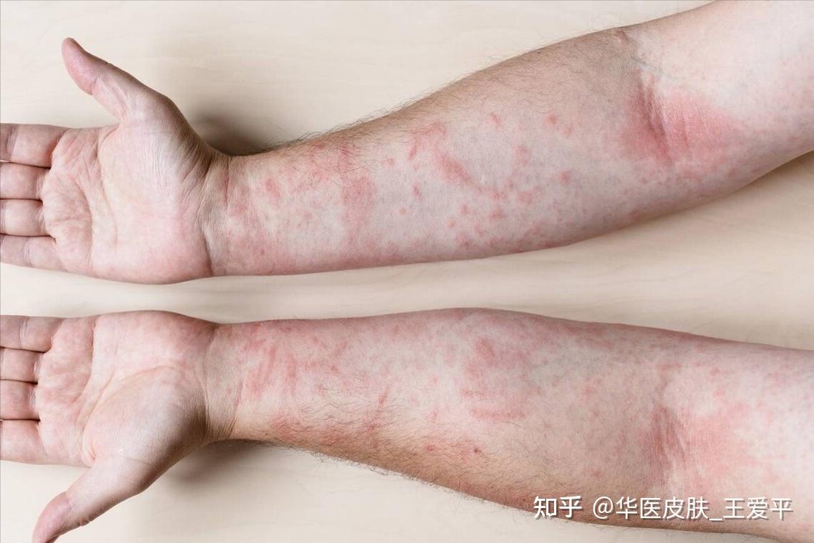 过敏性皮炎能自愈吗？危害有哪些？体质变差最直接 - 知乎