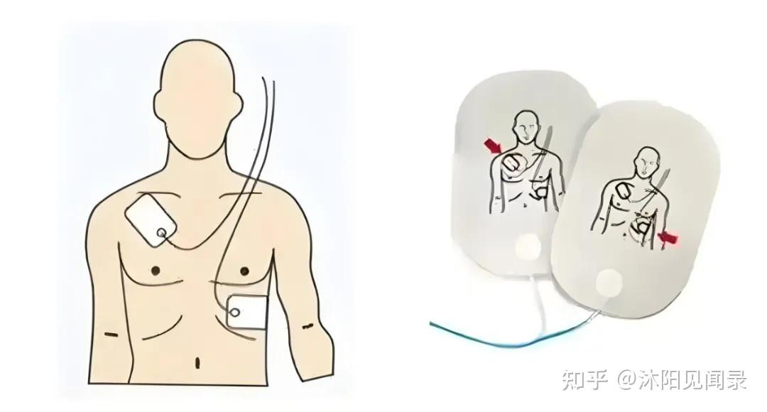 AED电极片贴反了怎么办 - 知乎