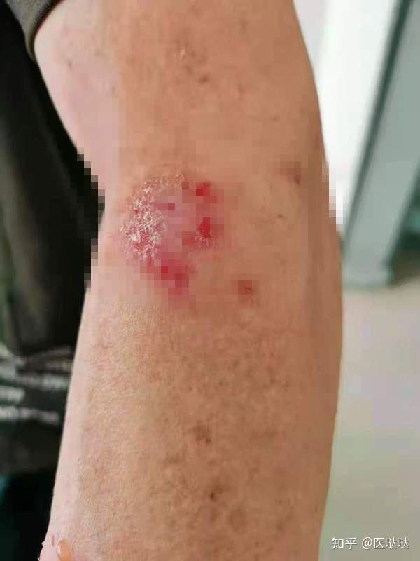 虽在基层诊所 却得到患者不断认可 无数人慕名来找他看皮肤病 知乎