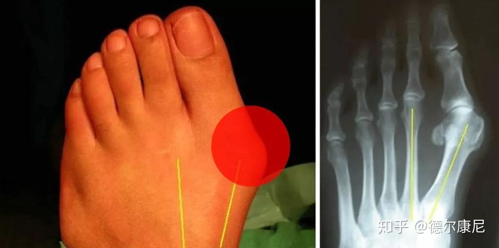 拇趾在第一跖趾关节处向外偏斜超过正常生理范围,我们称之为拇外翻