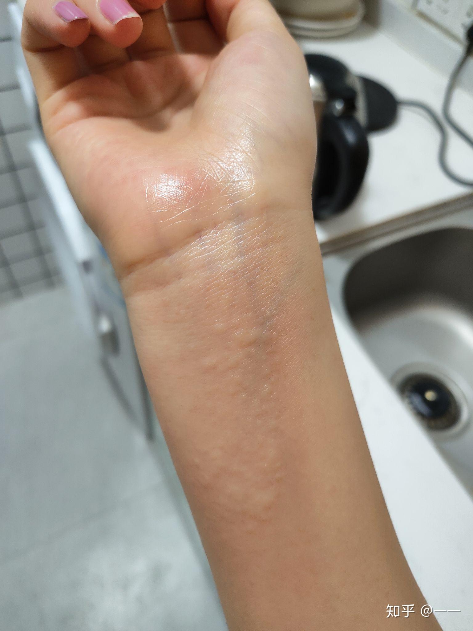 手腕为什么会突然痒痒?然后一抓就起一粒粒的痘痘?