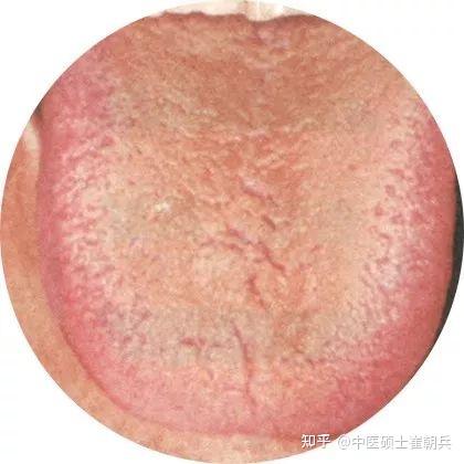 史上最全高清舌诊图谱,堪比教科书(收藏篇) - 知乎