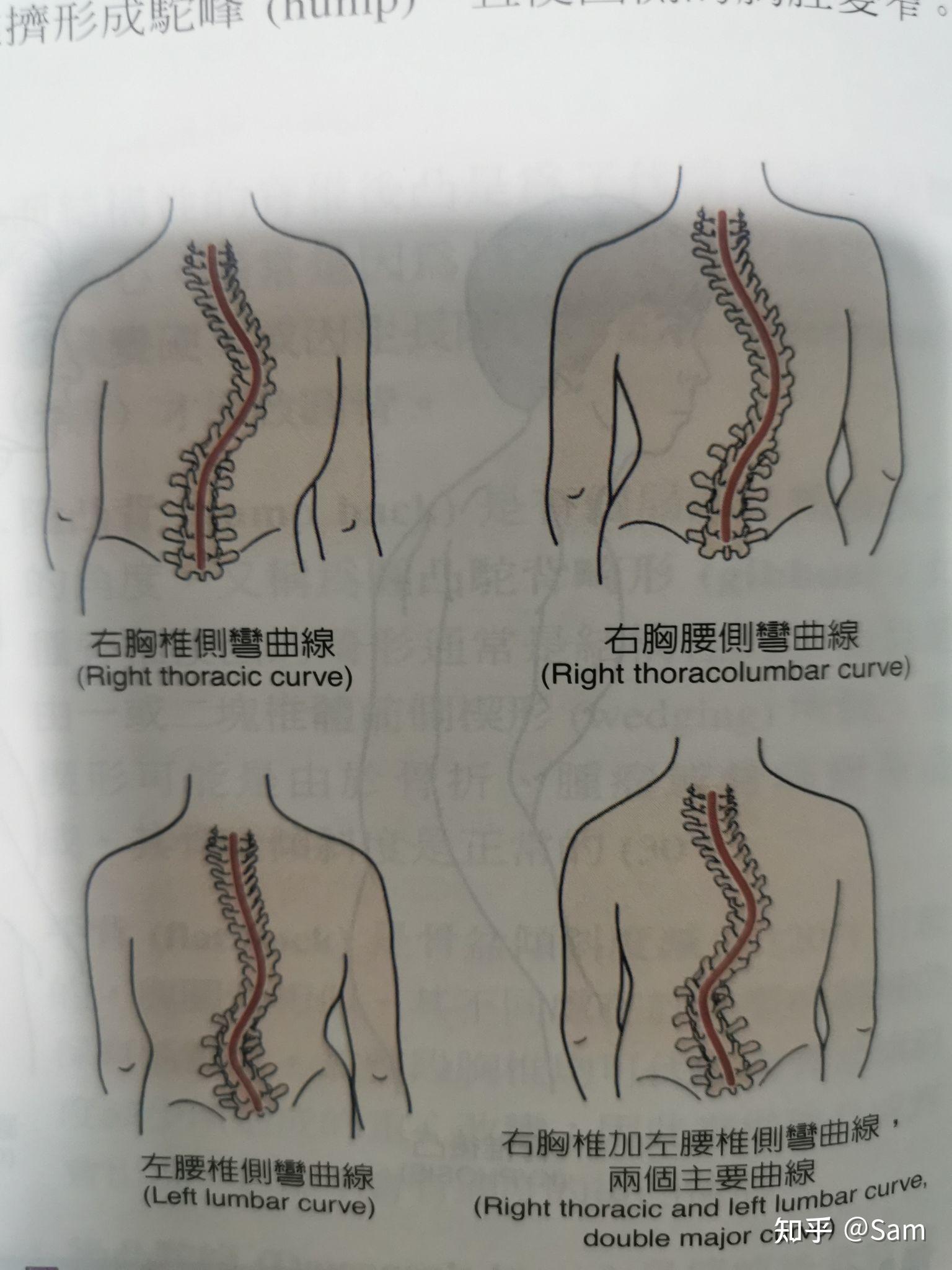 脊柱后凸度数对照表图片