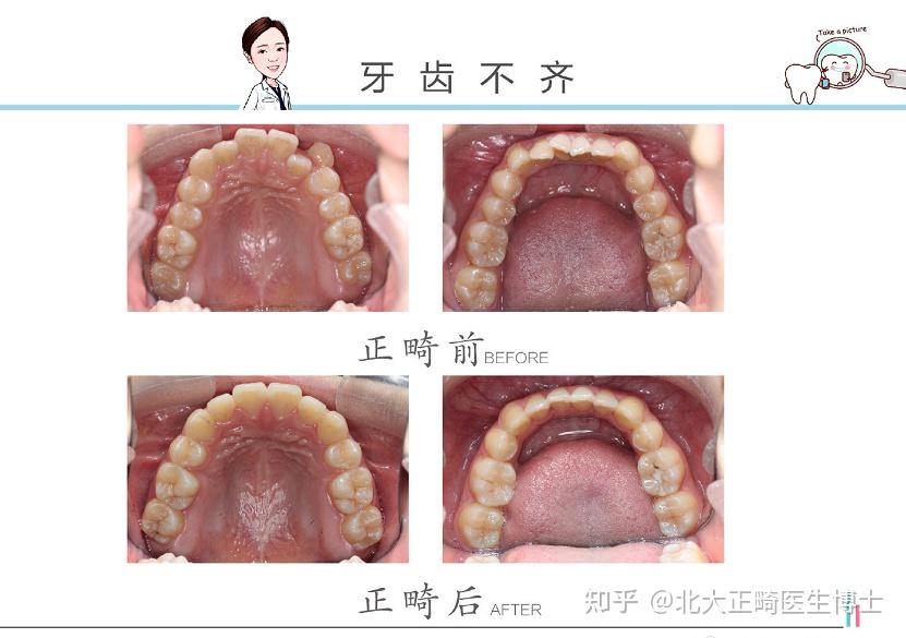 鄭州牙齒矯正醫生曹甜矯正內收13毫米麵型會有什麼變化嗎