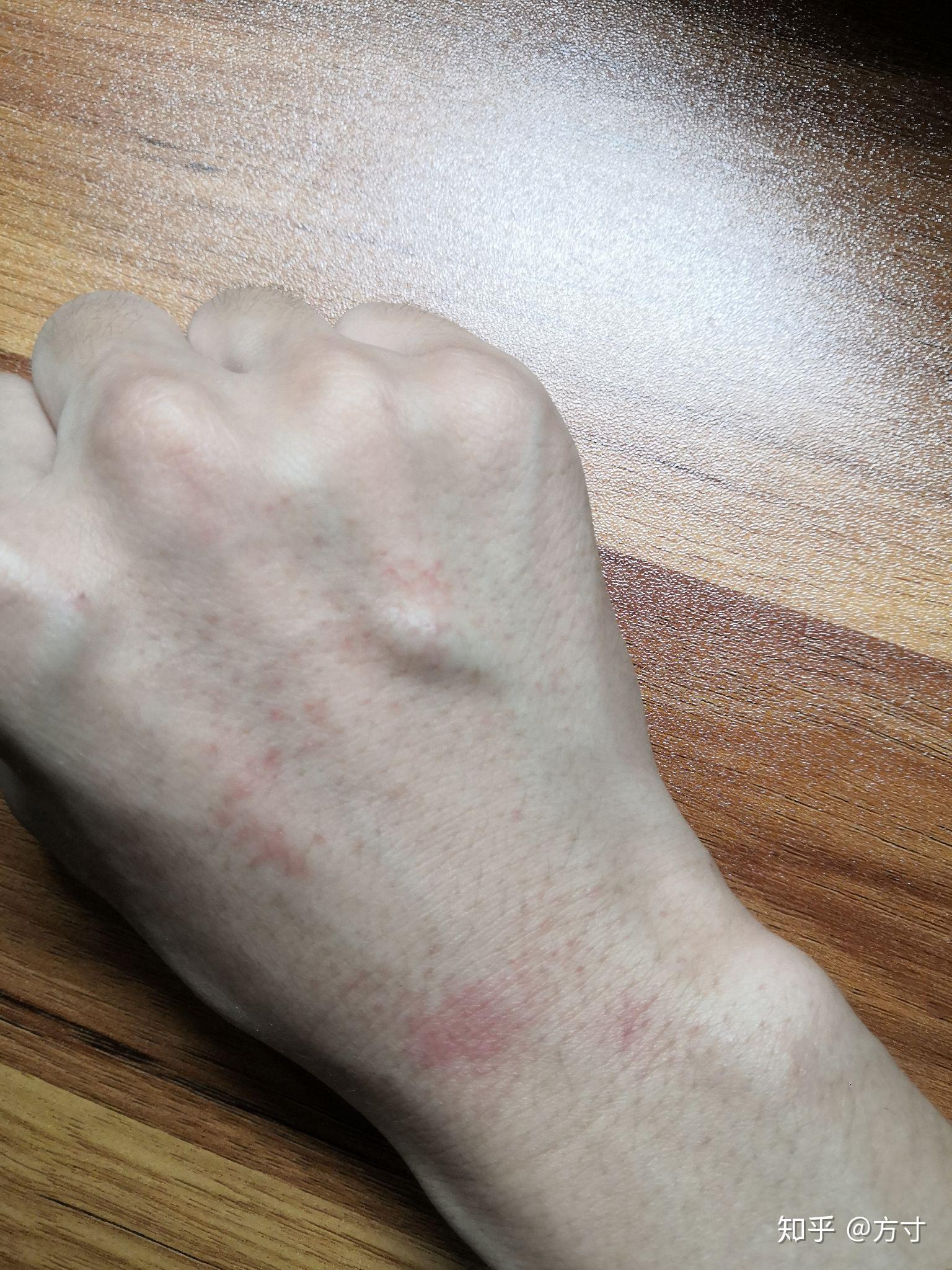 两手背出现红疹,胳膊有褪皮,嘴唇依旧干燥起皮,痘痘还有,面部已经下去