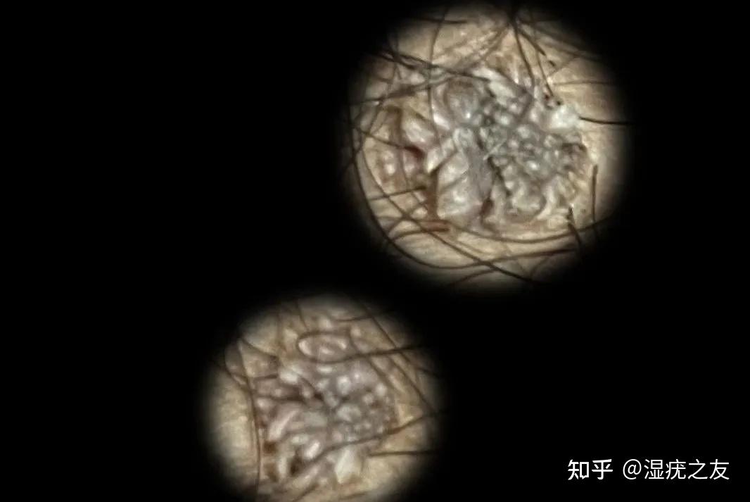 尖锐湿疣疣体是黑色的吗? - 知乎