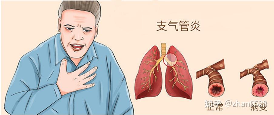 支气管炎该如何确诊？会不药而愈吗？ - 知乎