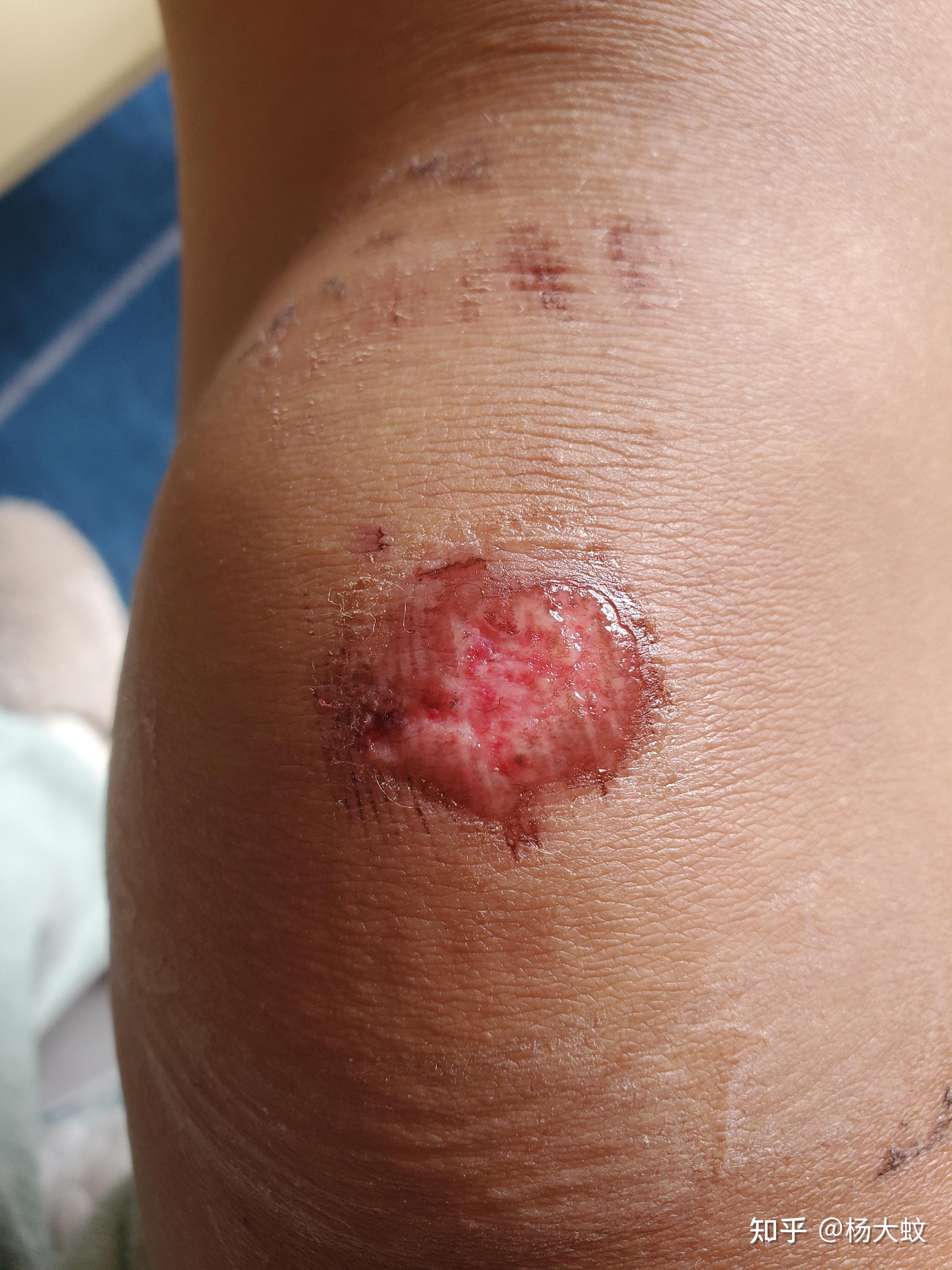 记录一下膝盖磕破皮的痊愈过程