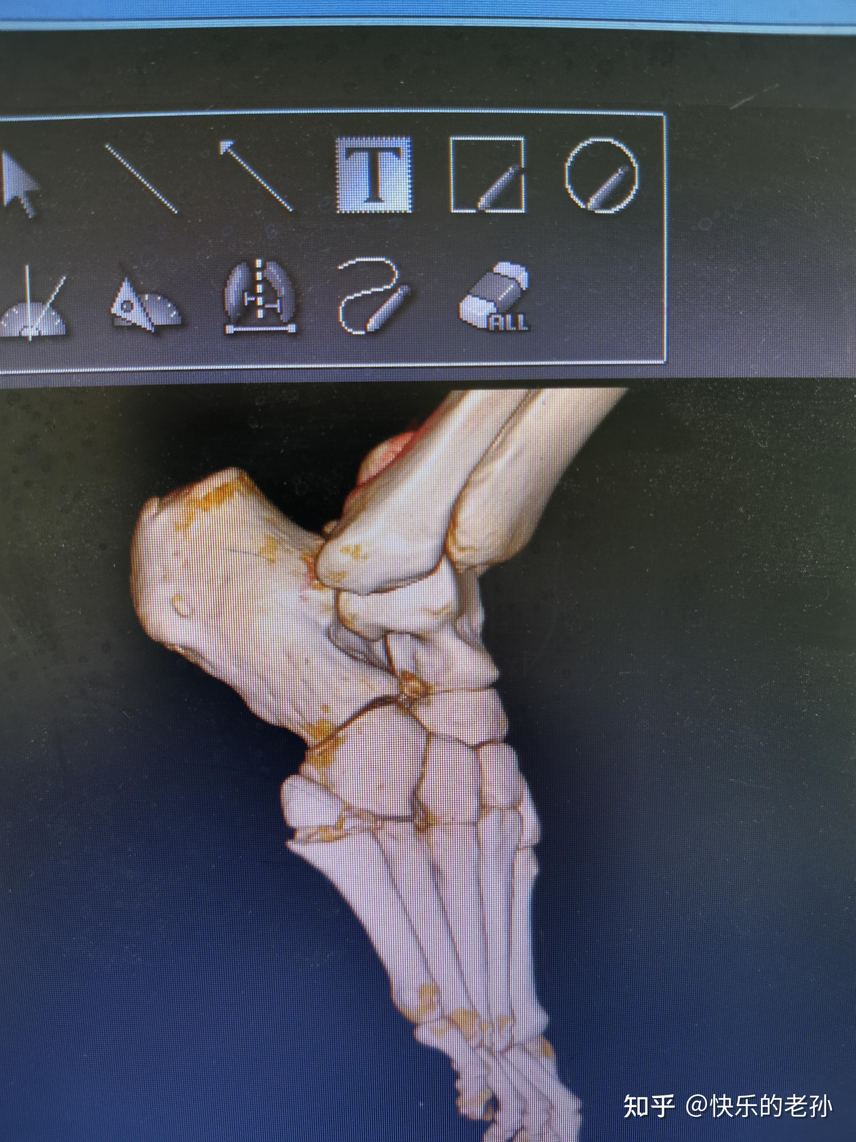 第五跖骨基底部骨折图图片