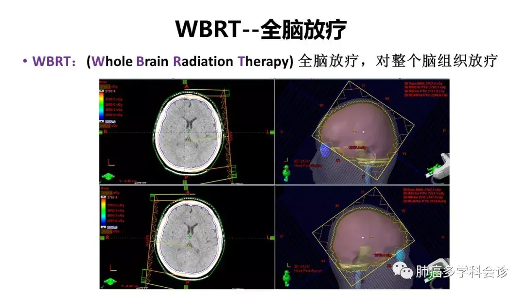 SRS 和全脑放疗怎么选择用才能让肺癌脑转移患者最大获益? - 知乎