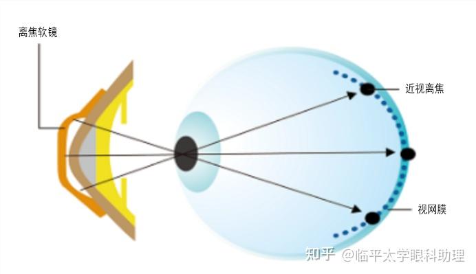OK镜、近视离焦镜、离焦软镜、平光离焦镜,几种近视防控产品哪种更好? - 知乎
