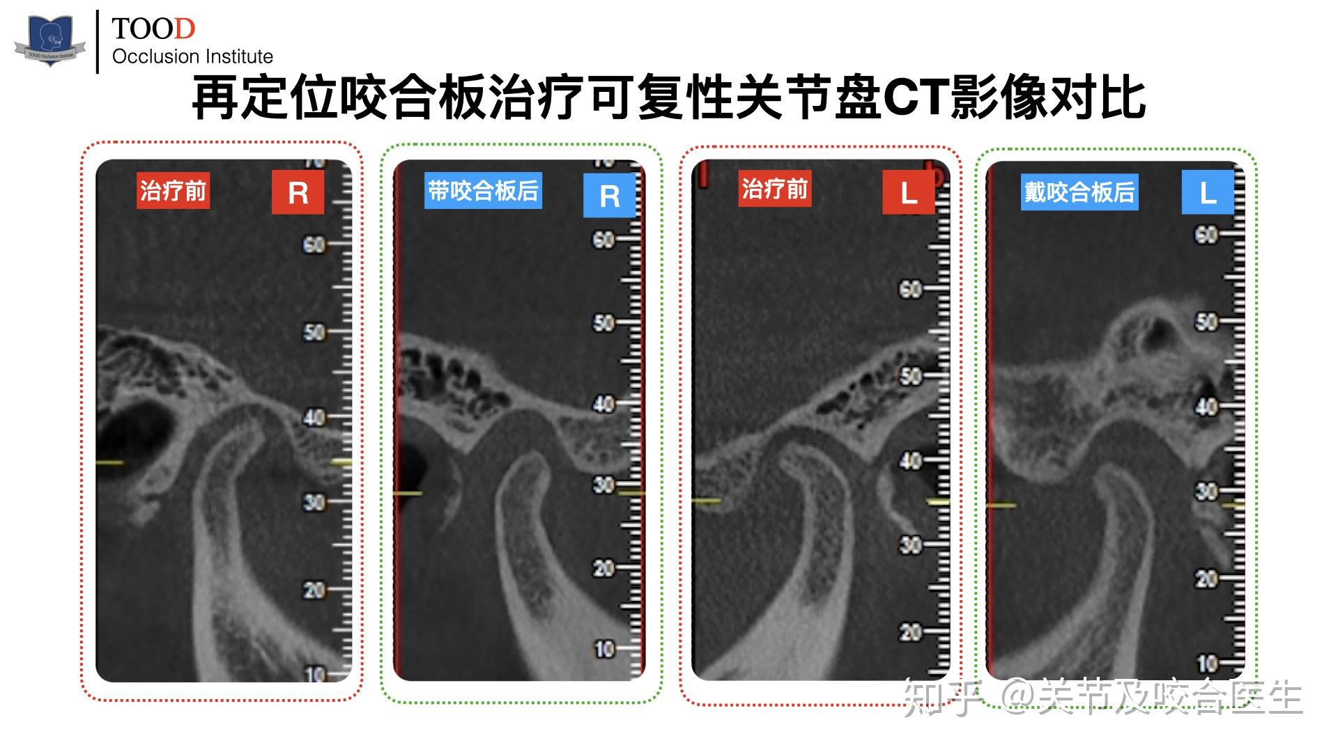 不可忽視的顳下頜關節彈響