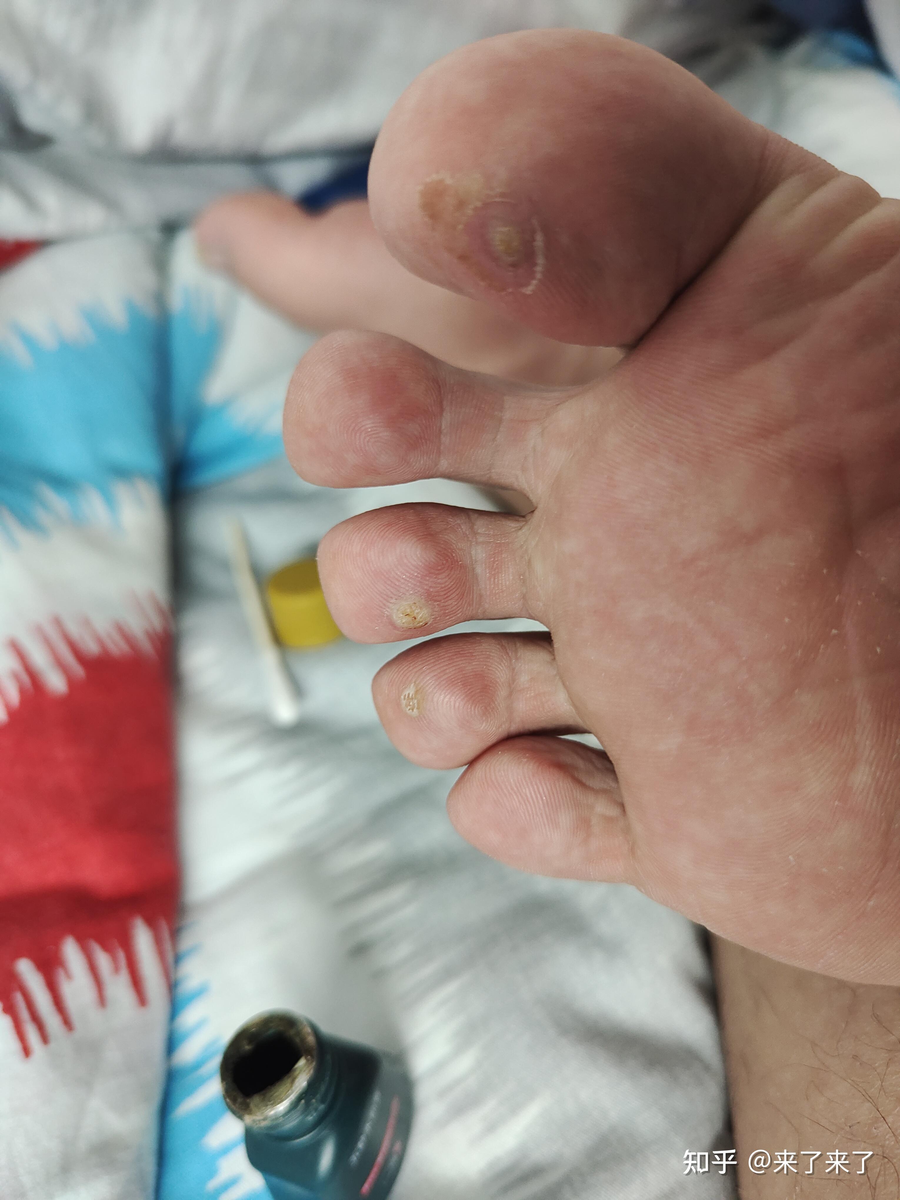 啊左下角那个药叫五妙水仙膏医院开的,贼贵170没啥效果现在在足疗店治