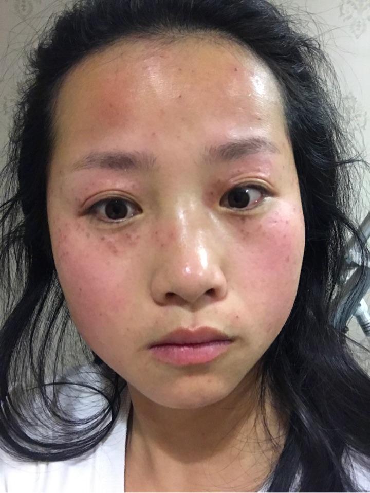 激光去除雀斑效果和流程要去雀斑的美眉不要走弯路哦