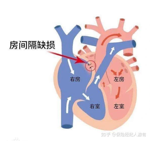 新生儿房间隔缺损4mm图片