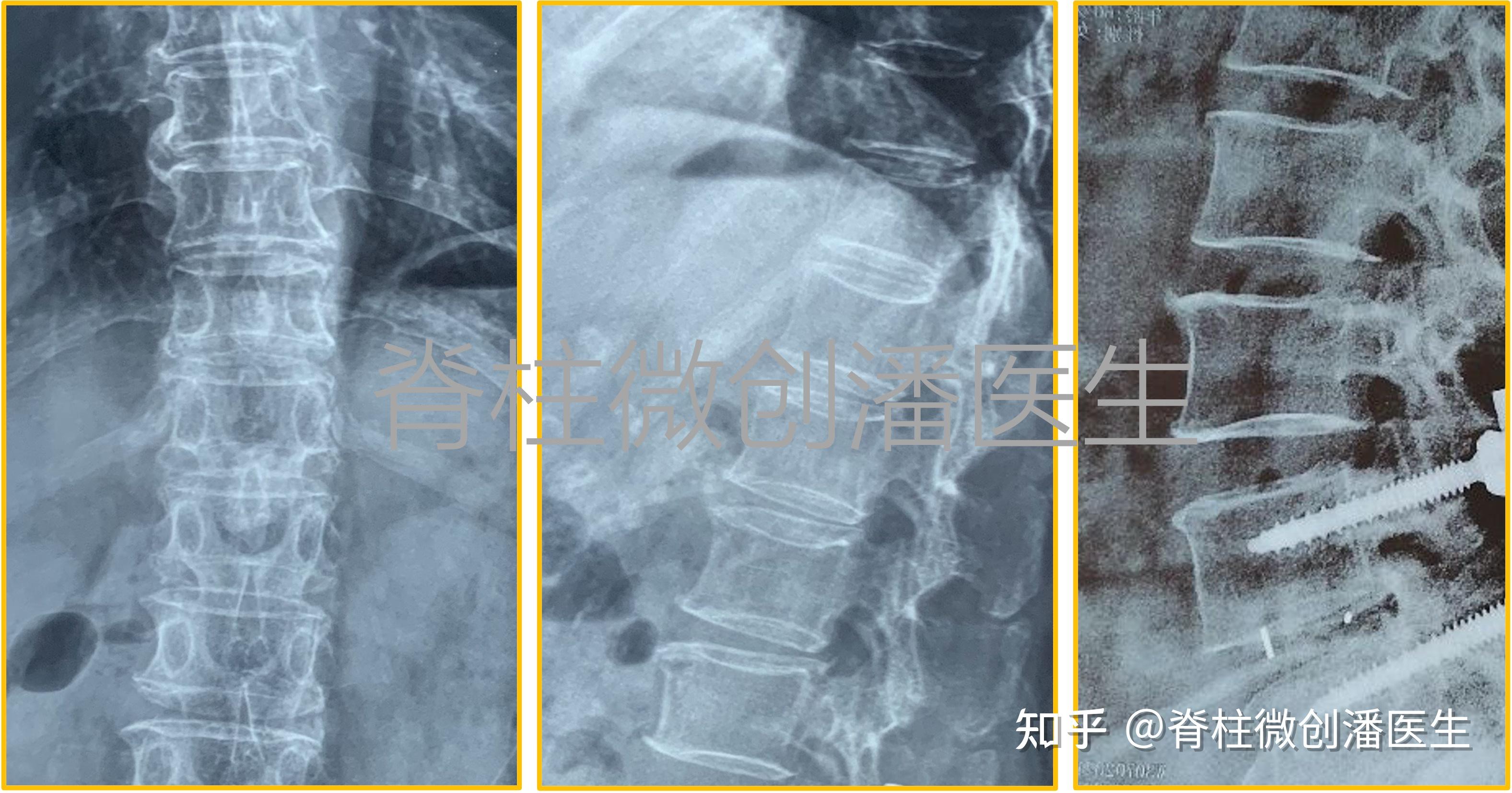 拍片发现的骨刺是怎么形成的?有什么危害? - 知乎