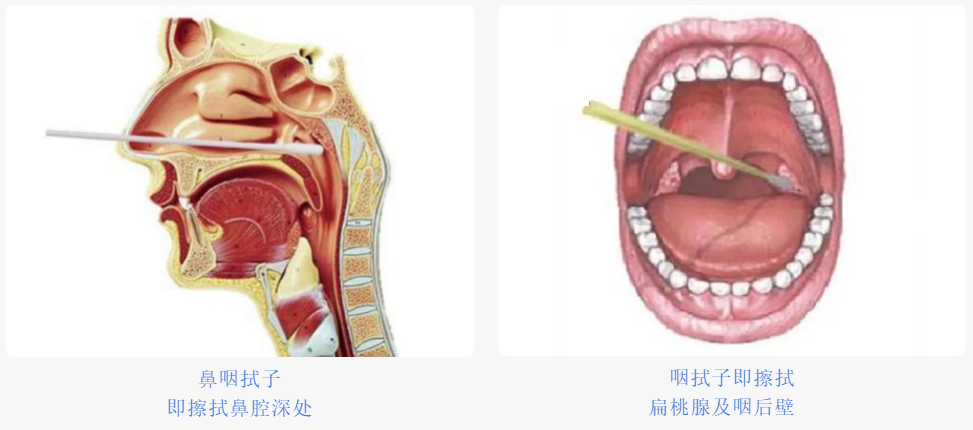 4,然后缓缓取出拭子,将拭子头浸入含2~3ml病毒保存液的管中.