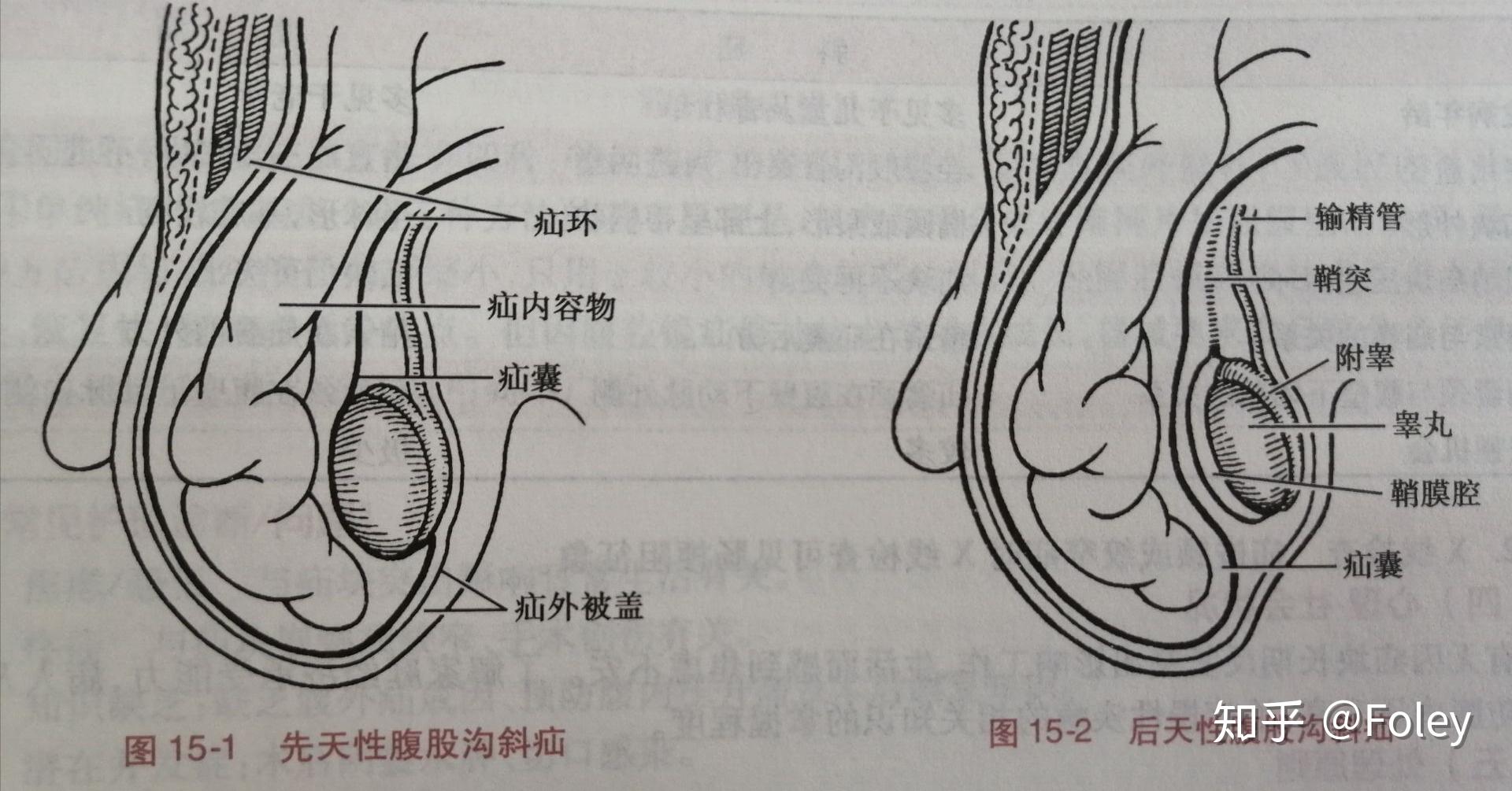 疝环口位置图示图片