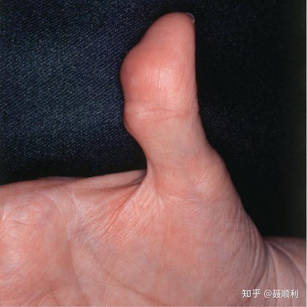 类风湿关节炎病人会有什么样皮肤改变(下) - 知乎